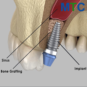 Sinus Lift