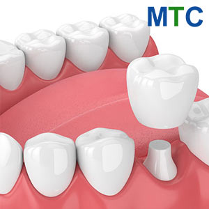 Dental Crowns