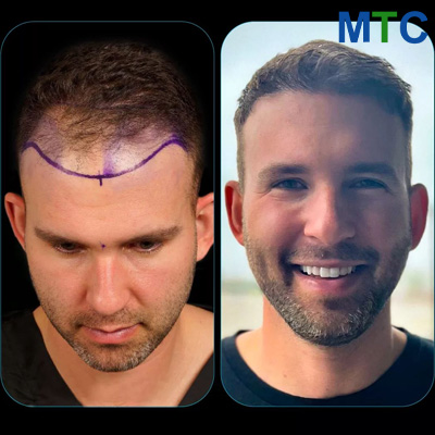 Before After Hair Transplant in Turkey