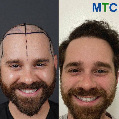 Before After Hair Transplant in Turkey