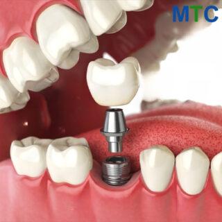 Standard dental implant in Cancun