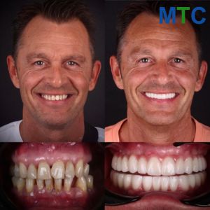 Smile Makeover in Turkey