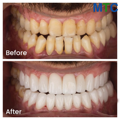 Veneers in Izmir, Turkey: Before/After