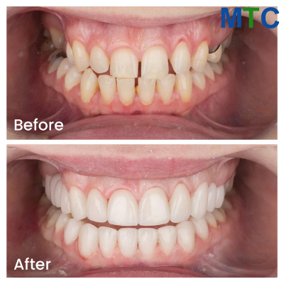 Veneers in Izmir, Turkey: Before/After