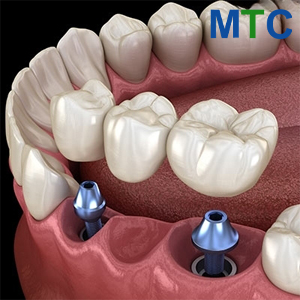 Dental Bridge Turkey