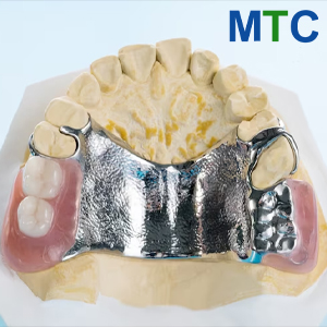 Cast Metal Partial Denture Los Algodones