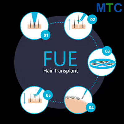 FUE Hair Transplant in Turkey