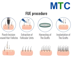 FUE | Hair Transplant for Women in Turkey