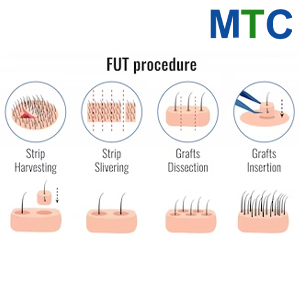 FUT | Hair Transplant for Women in Turkey