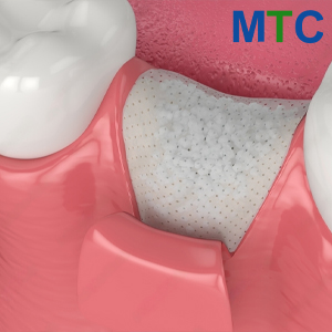 Bone Graft Before Dental Implants