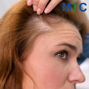 Androgenic Alopecia