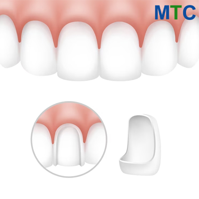 Dental veneer in Turkey