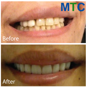 Dental Crowns in Mexico ( Before & After)