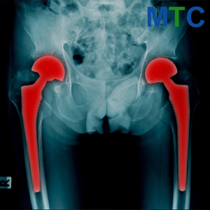 Bilateral Hip Replacement