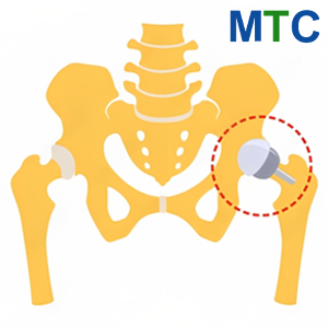 Hip Replacement Surgery in Mexico