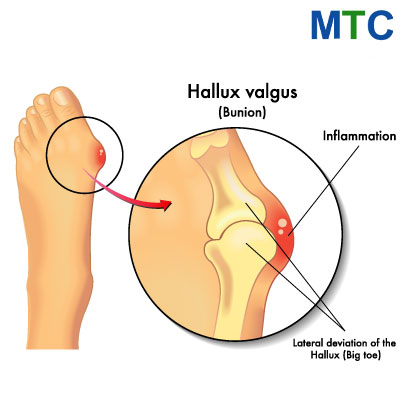 Hallux Valgus Surgery in Mexico