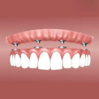 Overdenture