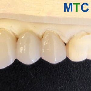 E-max Crowns