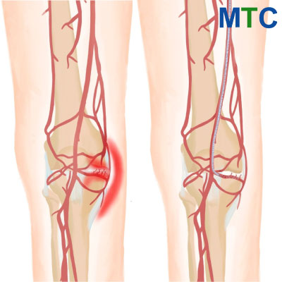 Genicular Artery Embolization (GAE) | Alternatives to knee replacement surgery