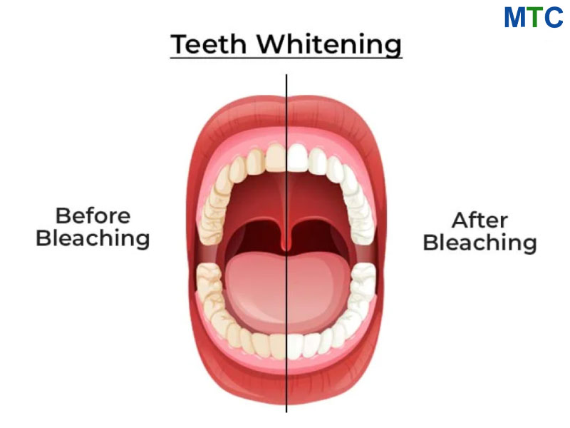 Teeth whitening in Cabo