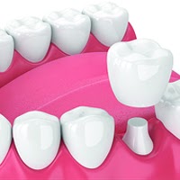 Dental Crowns in Vietnam