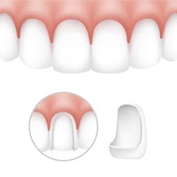 Porcelain Veneers in Vietnam