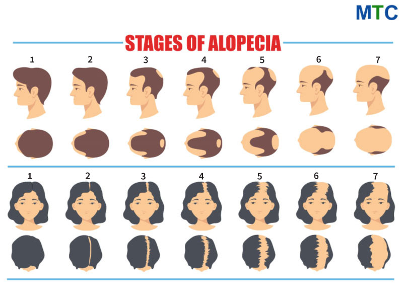 Norwood Classification Scale for pattern hair loss