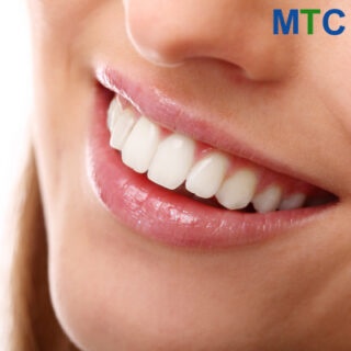 Veneers improve smile