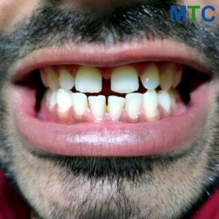 Veneers close teeth gaps